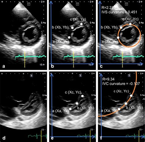 interventricular septum thickness measurement|found in the interventricular septum.